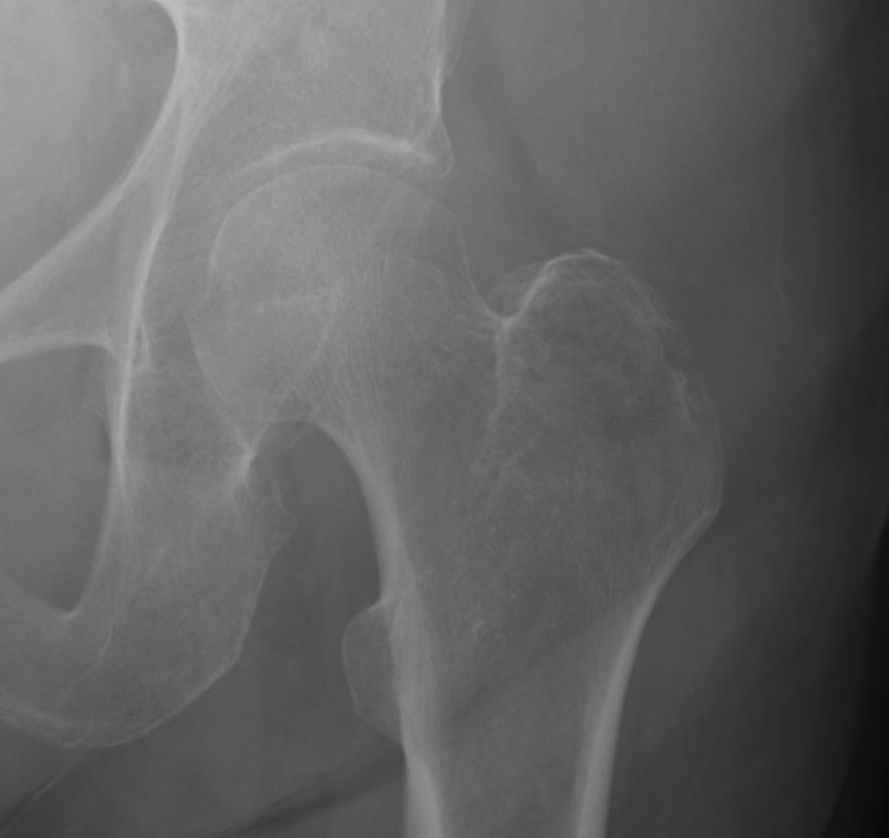 Isolated Greater Trochanter Fracture